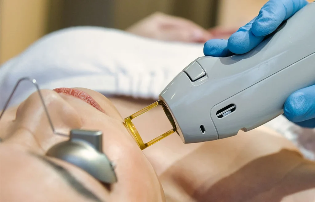 Laser hair removal treatment on face performed by professional technician