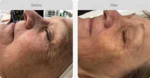Before and after skin rejuvenation treatment showing smoother, firmer skin