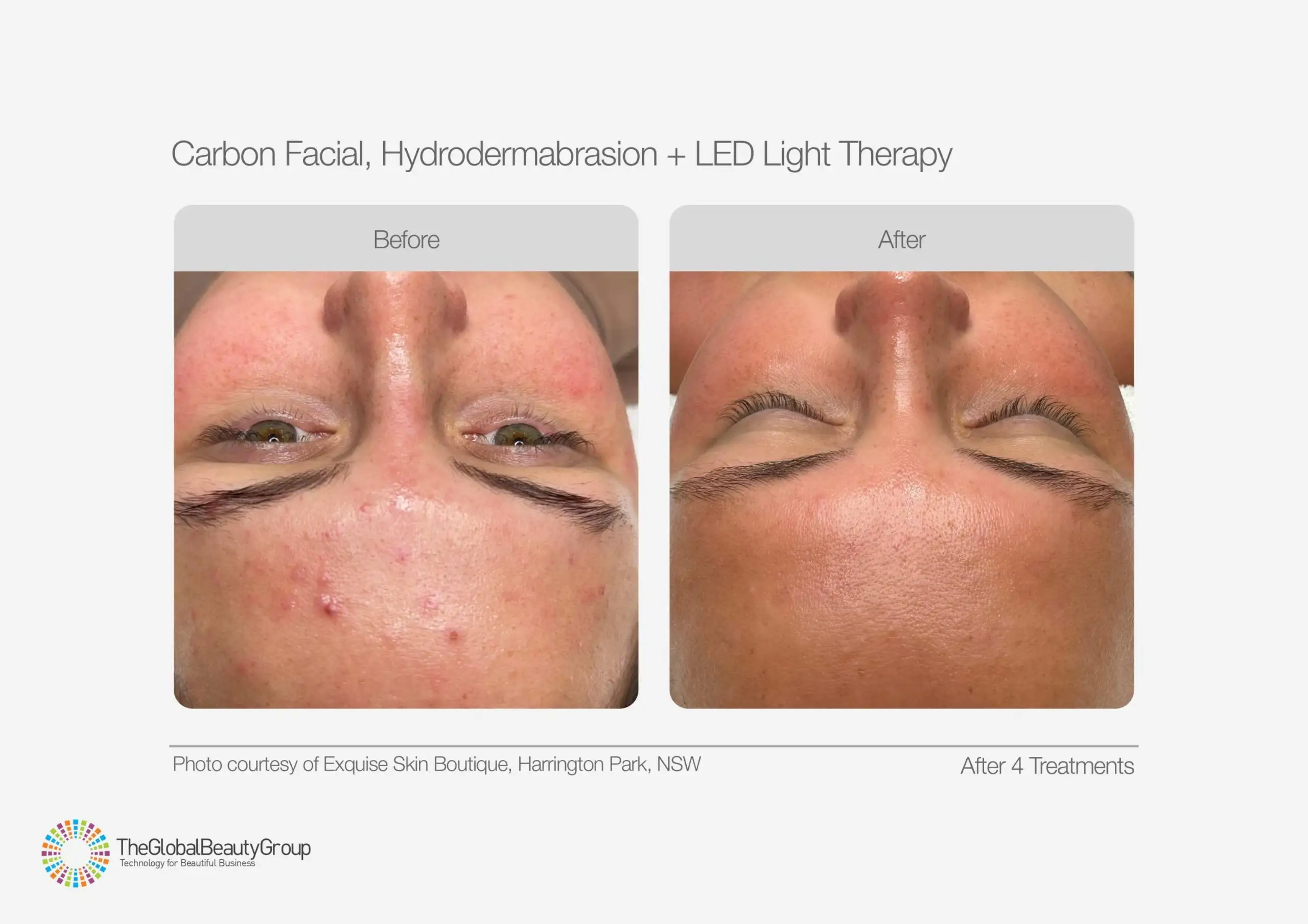 Before and after results of carbon facial, hydrodermabrasion, and LED light therapy