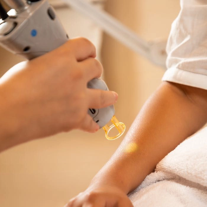 Laser hair removal treatment being performed on a client’s arm