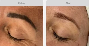 Before and after results showing eyebrow tattoo removal with natural regrowth