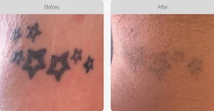 Before and after results showing faded star tattoos after laser removal treatment