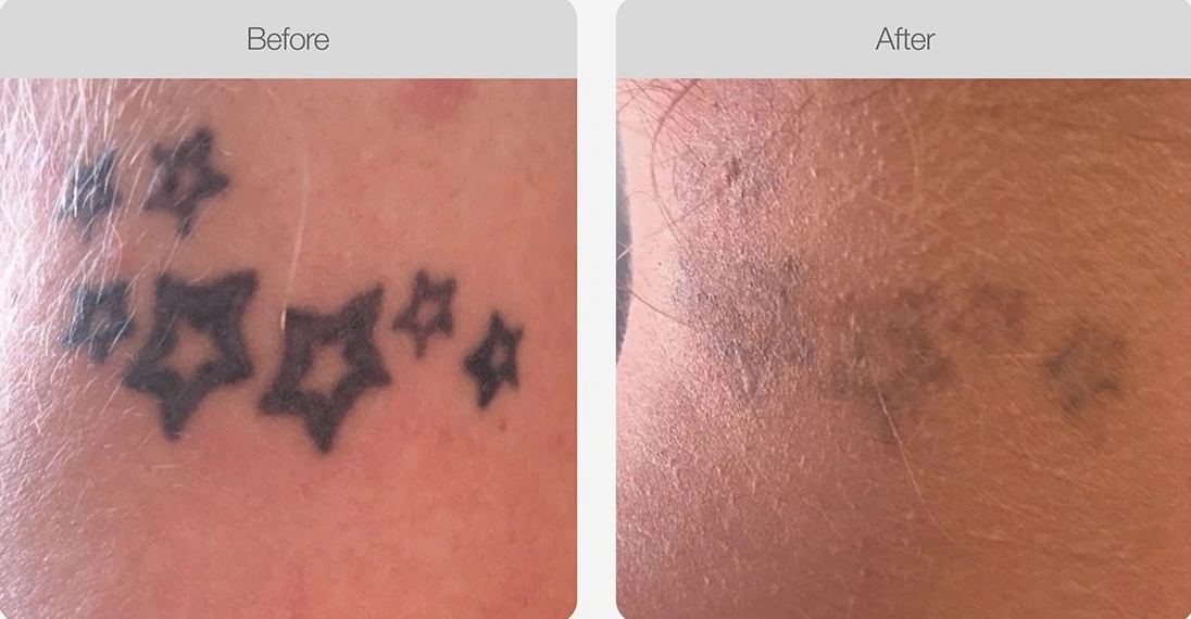 Before and after results showing faded star tattoos after laser removal treatment