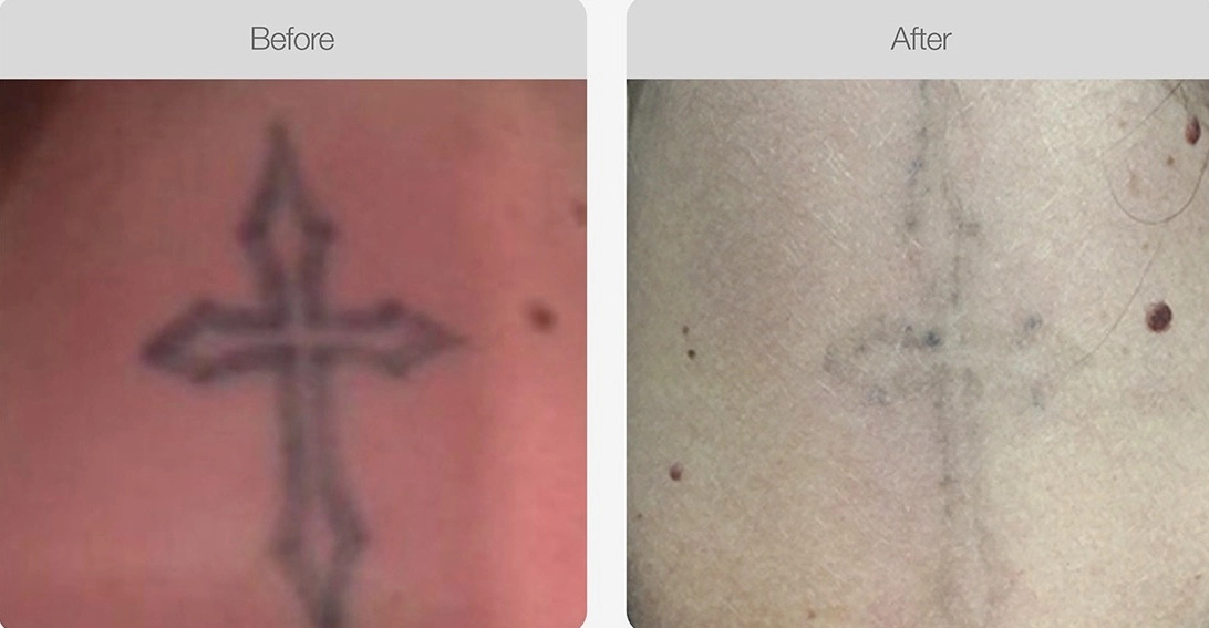 Before and after results showing faded cross tattoo after laser removal treatment