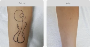 Before and after results showing complete tattoo removal from a forearm
