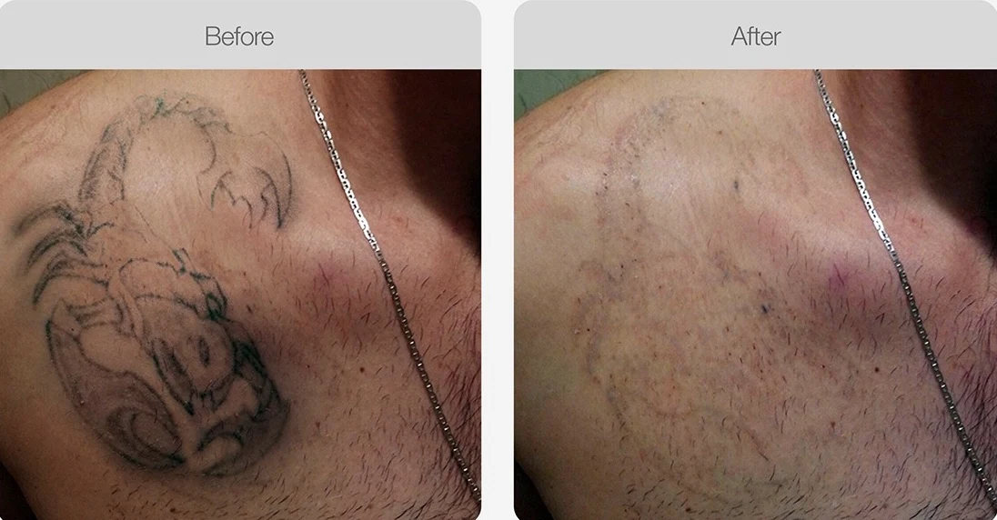 Before and after results of laser tattoo removal on the chest showing faded ink