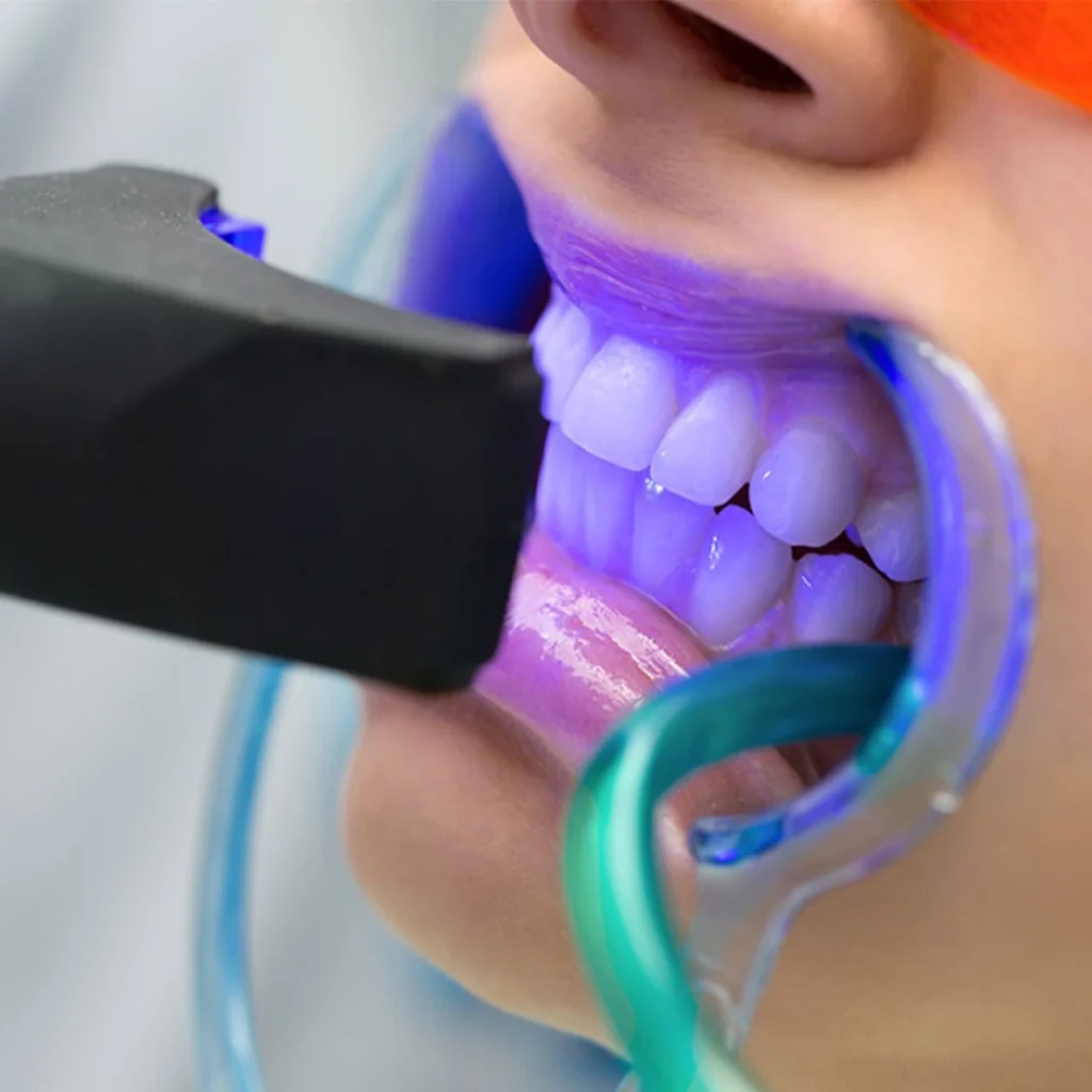 Professional teeth whitening treatment using blue LED light technology