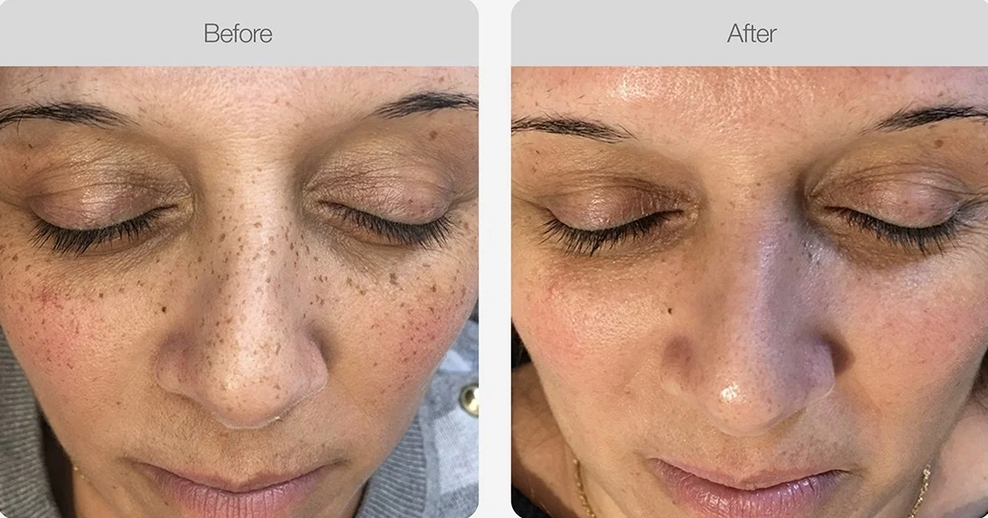 Facial freckles and spots reduced after skin treatment.