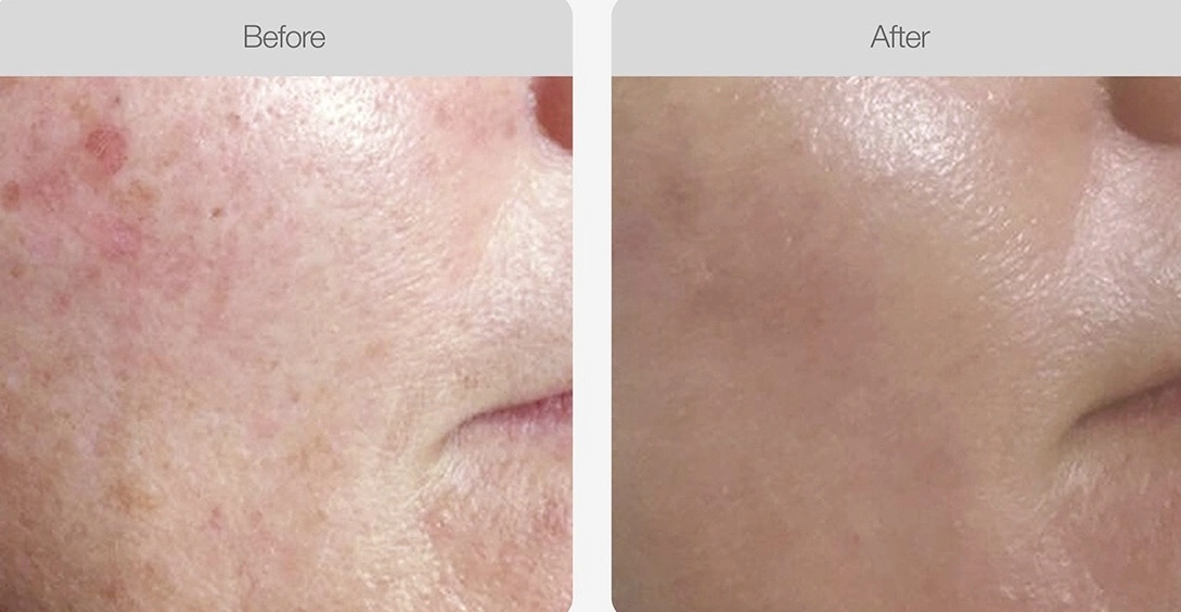 Facial spots and redness faded after skin treatment.