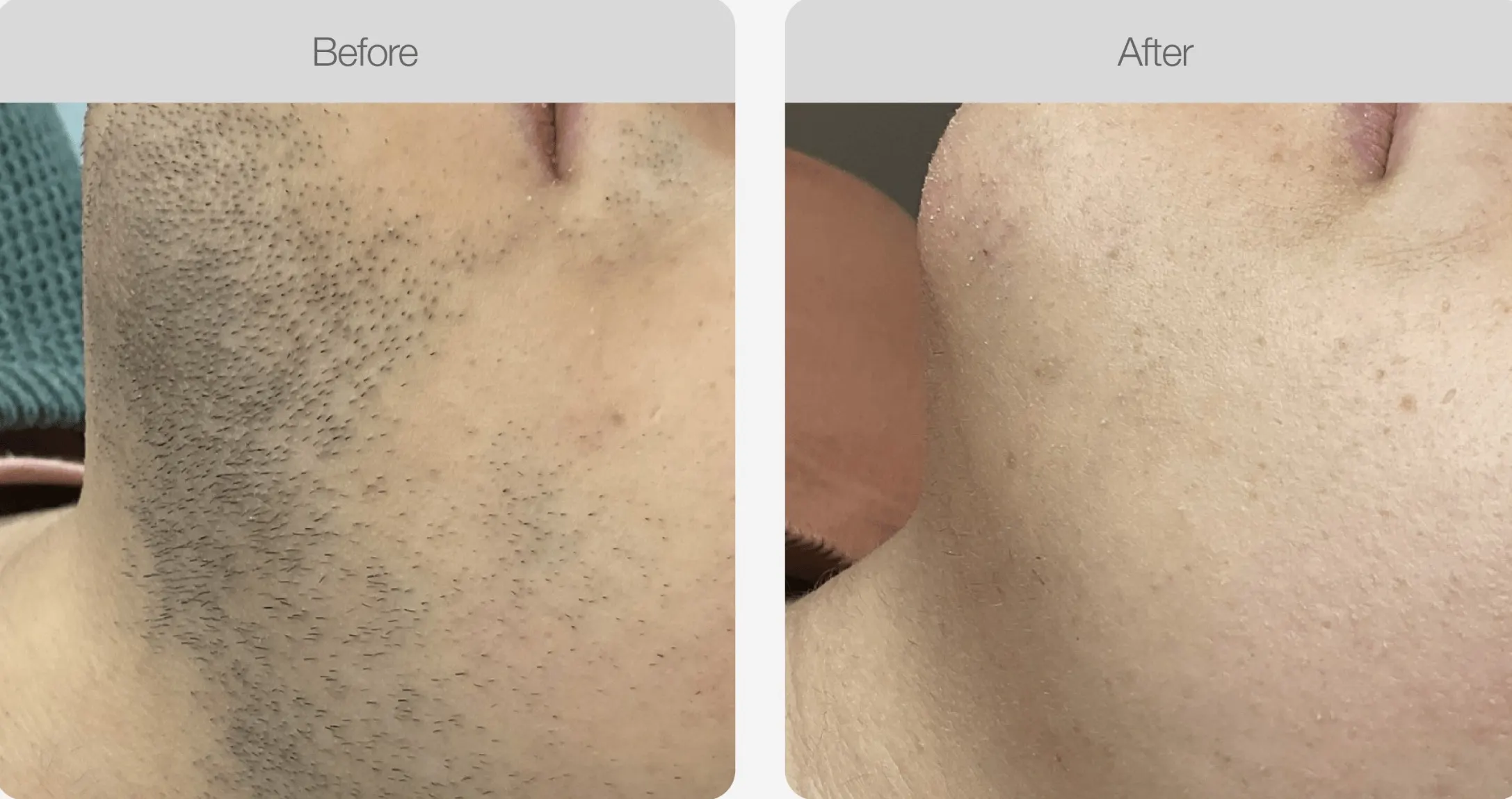 Facial hair reduced for smoother skin after treatment.