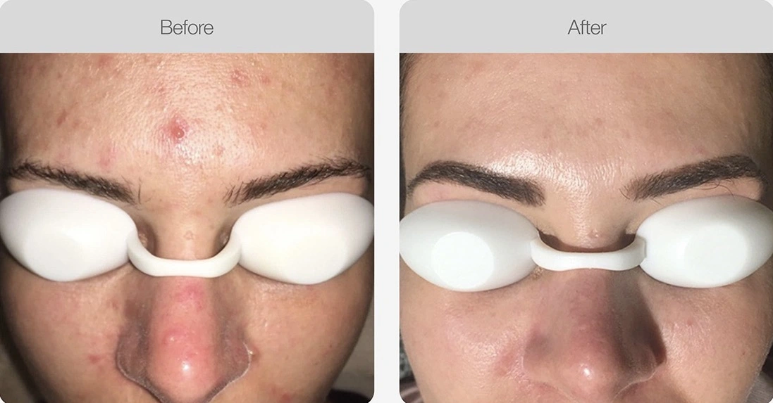 Facial acne faded after skin treatment, wearing eye protection.