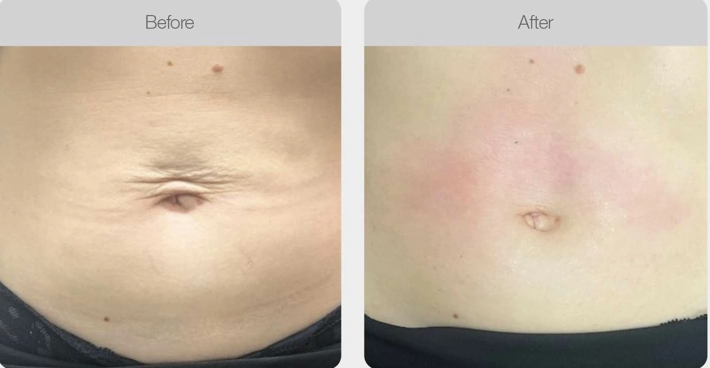 Stomach appears slimmer after body contouring.