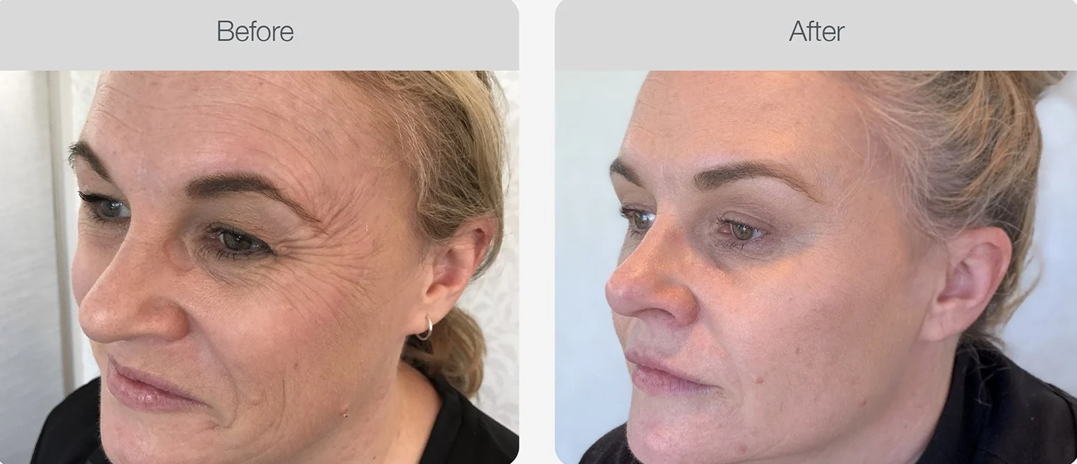 Facial wrinkles reduced after treatment.