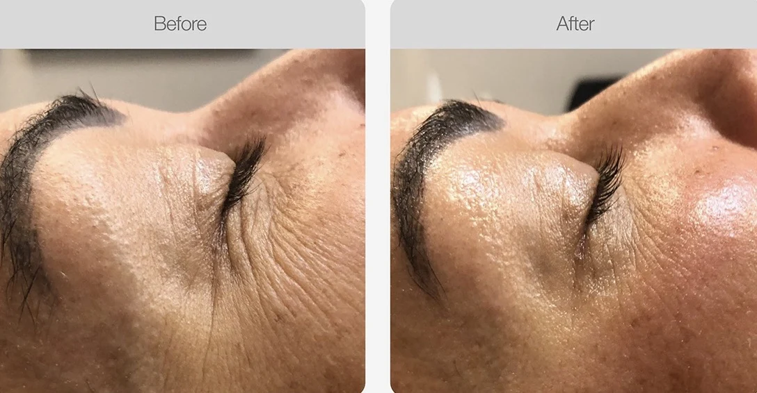Crow's feet wrinkles reduced after treatment.