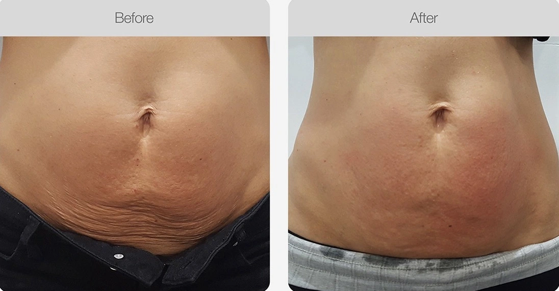 Stomach appears slimmer after body contouring.