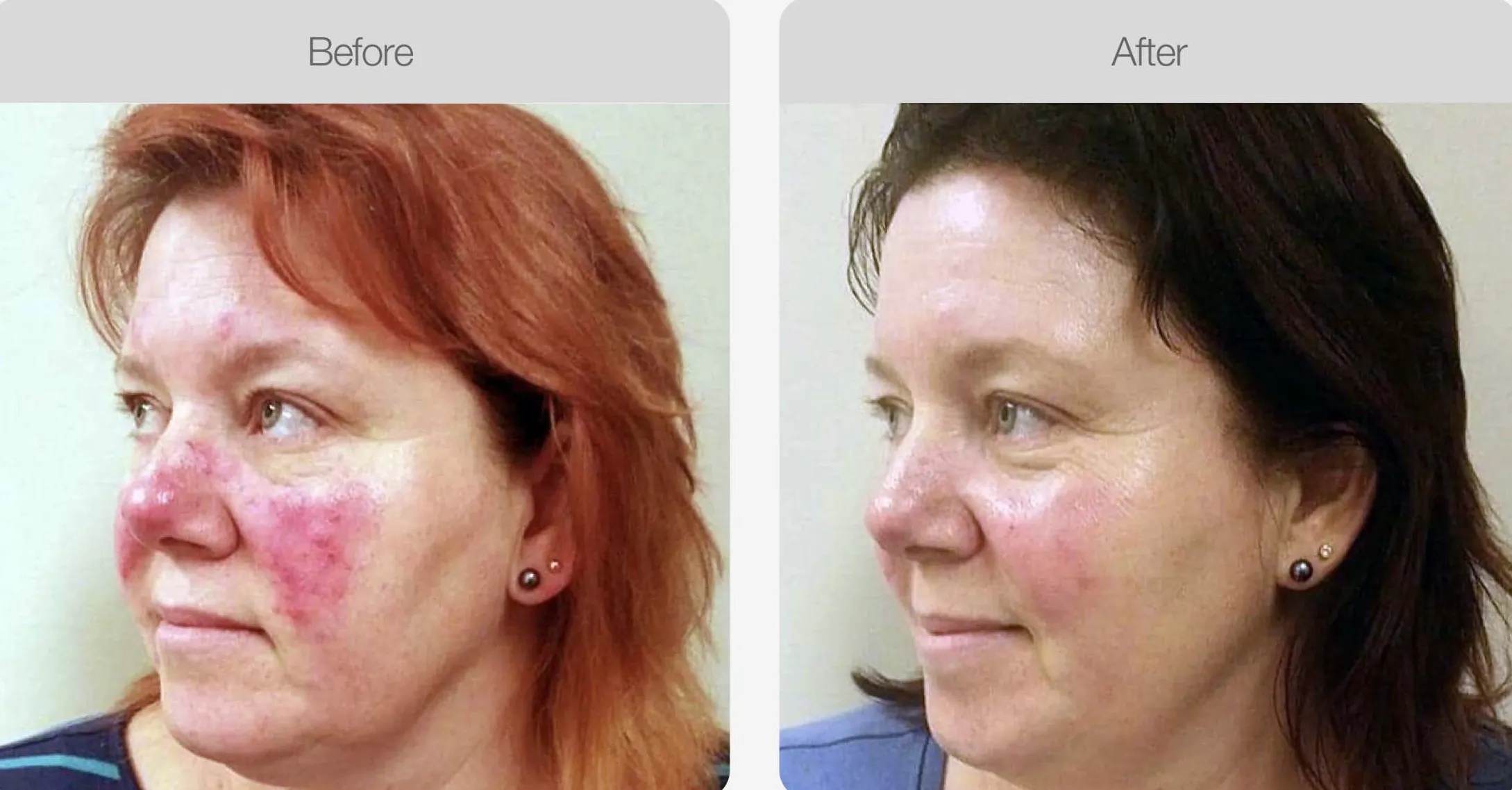 Before-and-after comparison showing reduced facial redness on a woman’s cheeks and nose.