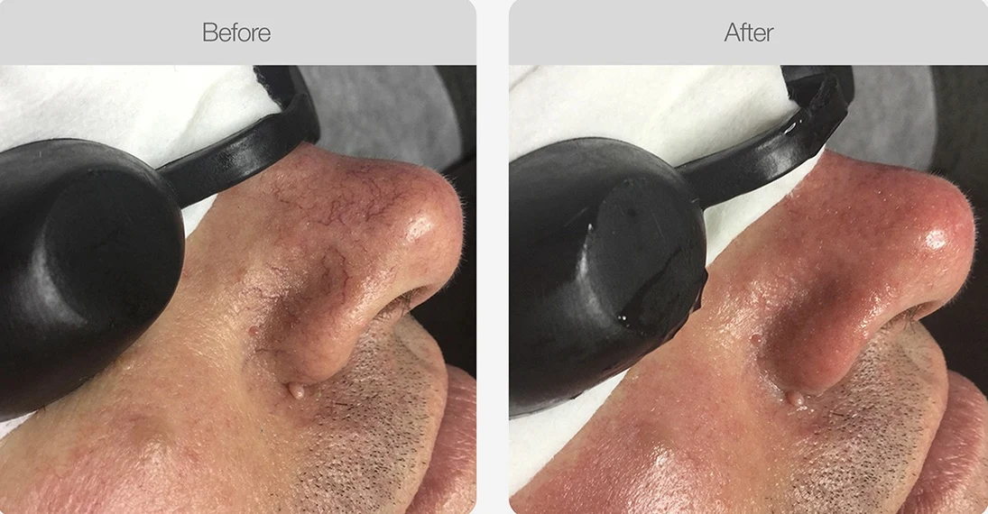 Before-and-after comparison of a nose showing reduced visible veins and smoother skin.