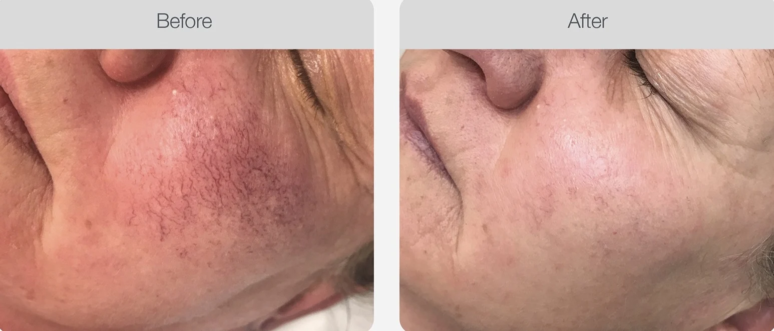 Clearer cheek skin after redness treatment