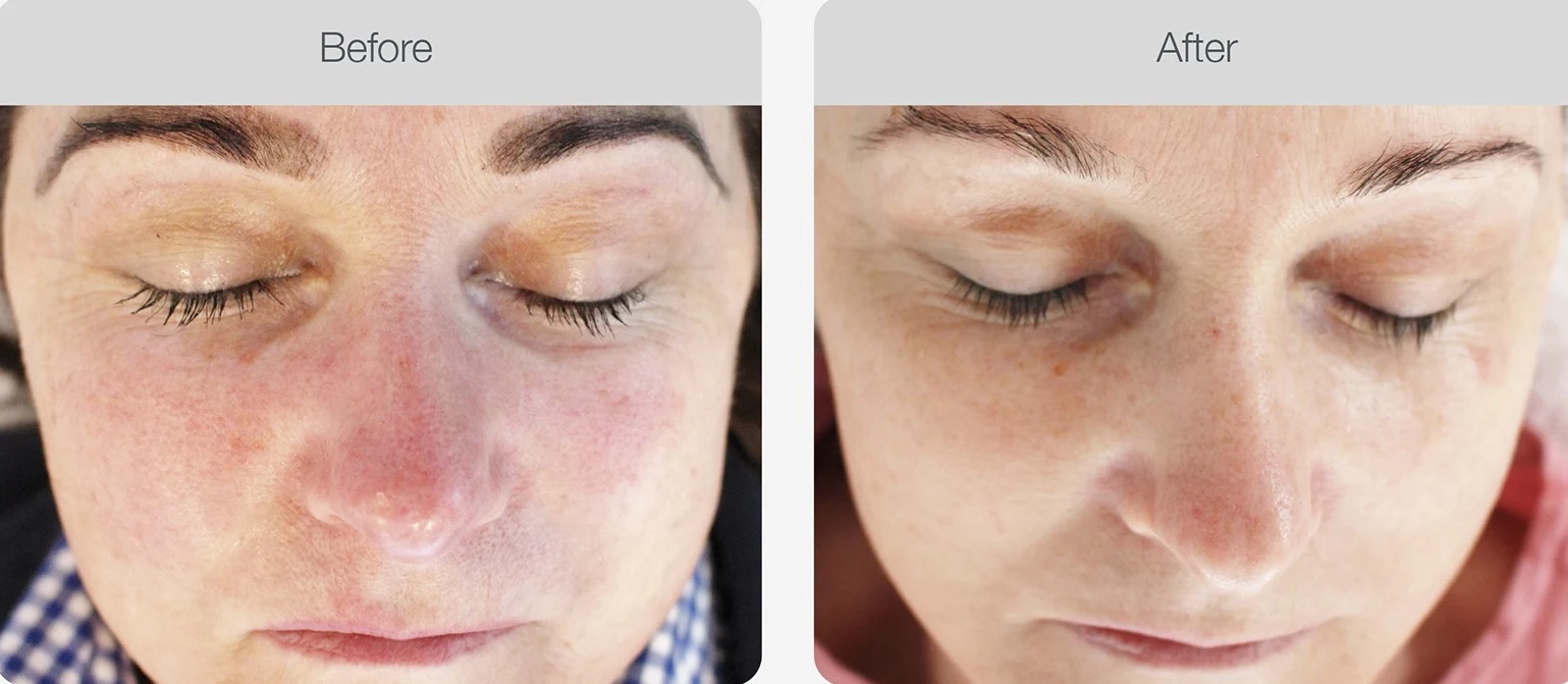 Red cheeks before treatment, clearer skin after, eyes closed in both views.