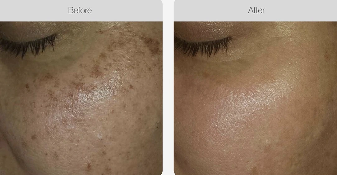Dark spots and pigmentation faded after skin treatment.