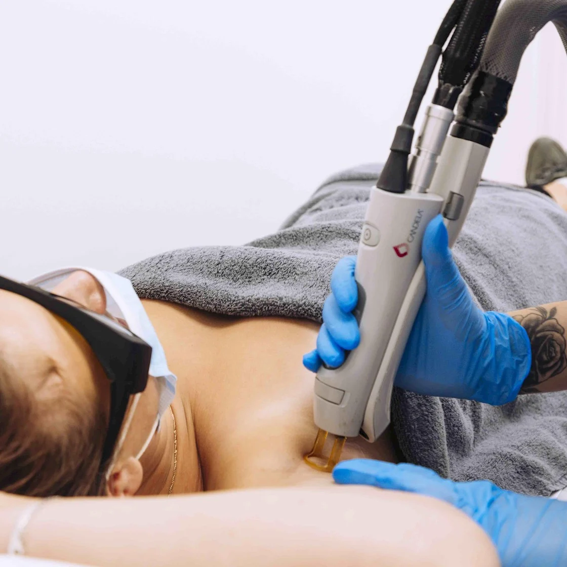 Candela laser device used for professional hair removal treatment on smooth skin.